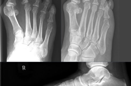 Bunion X-Ray