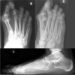 Bunion X-Ray