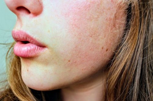 Get Rid Of Dry Skin