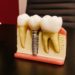 Dental Implants Vs Dentures
