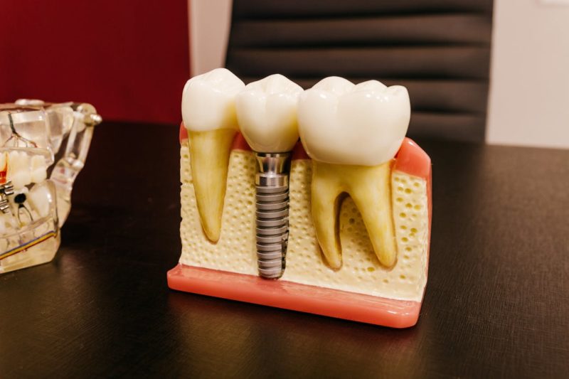 Dental Implants Vs Dentures