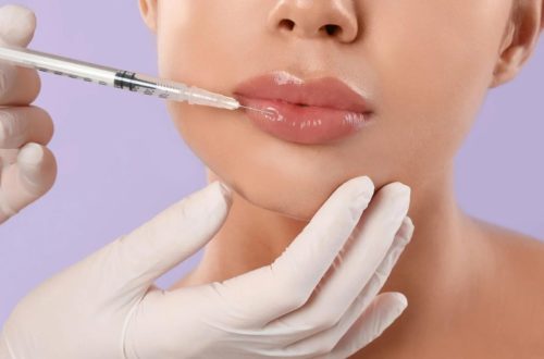 Hyaluronic Acid Lip Fillers