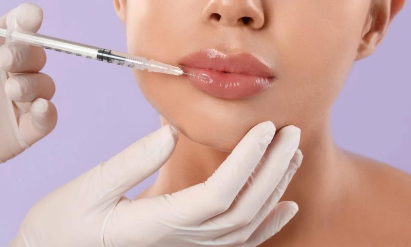 Hyaluronic Acid Lip Fillers